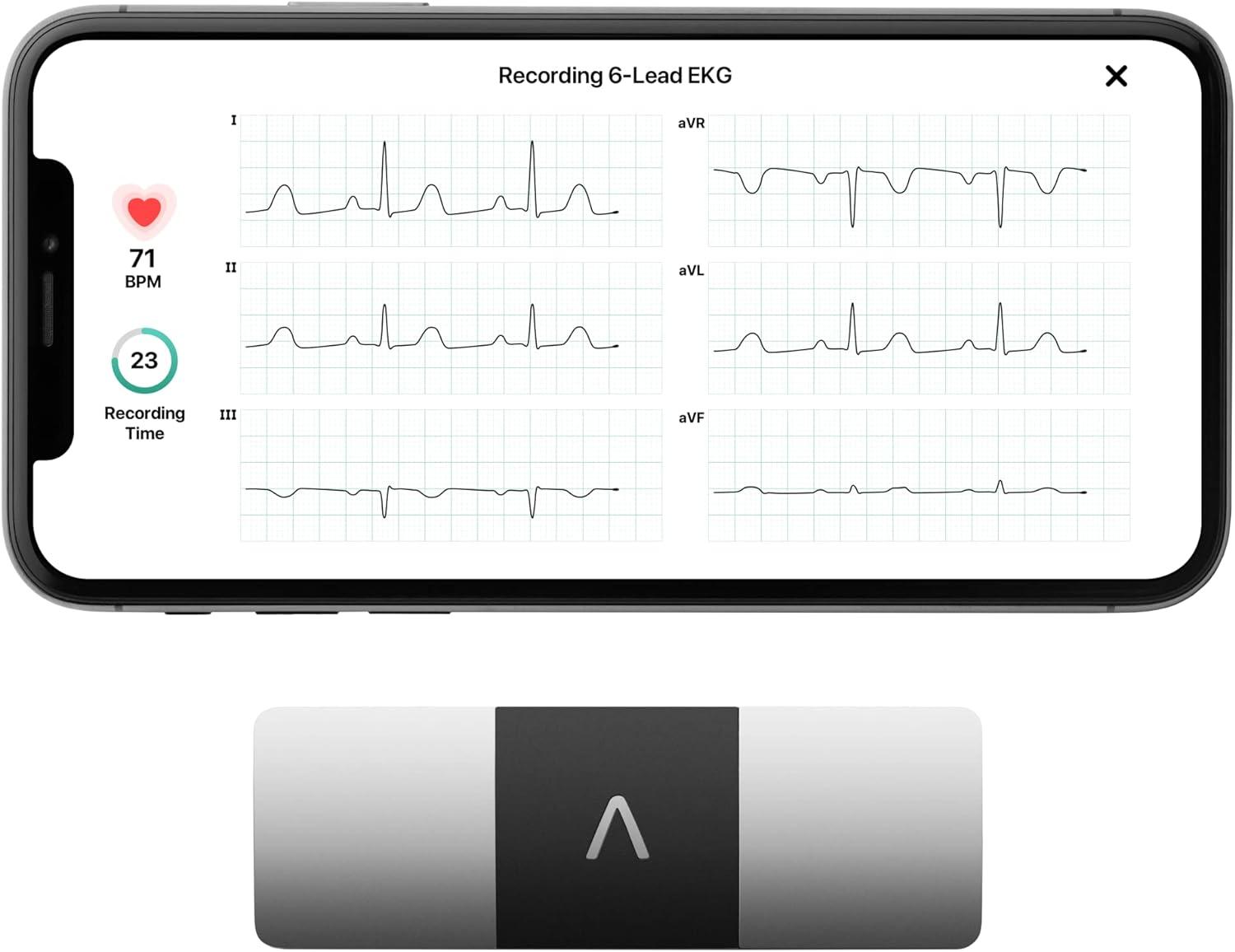 Smartphone EKG Showdown: Surprising Heart Insights in 30 Seconds