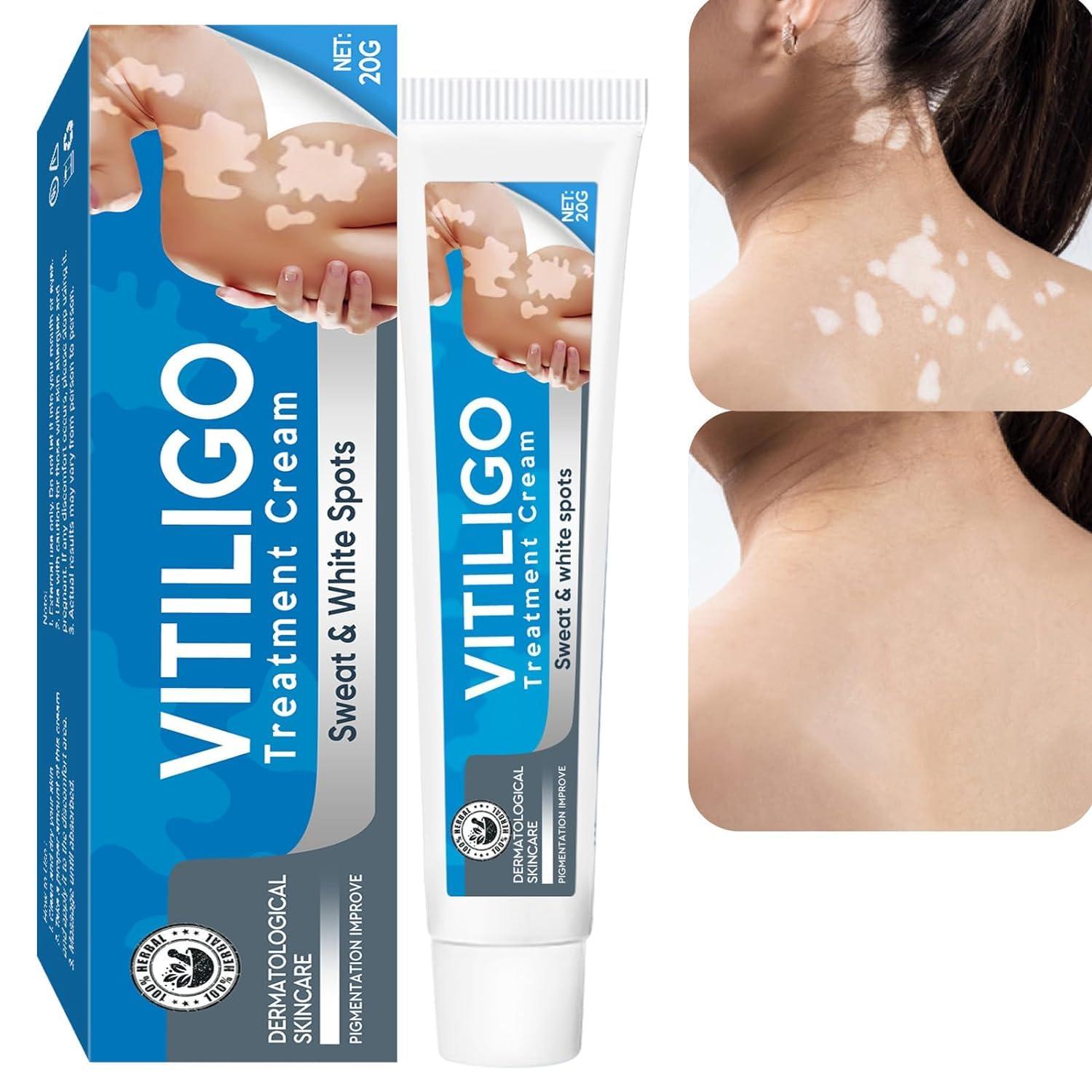 Vitiligo Cream Showdown: Natural, Sensitive Skin Safe?